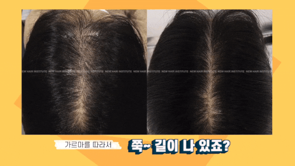 정수리 탈모, 방치했다면 회복이 늦어지는 이유 관련 이미지 6