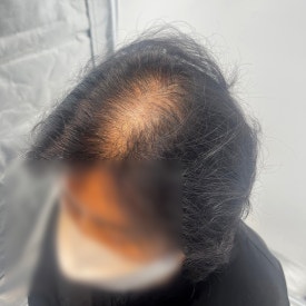 여성두피문신? 60대 실제 사례 사진으로 확인하세요 관련 이미지 4