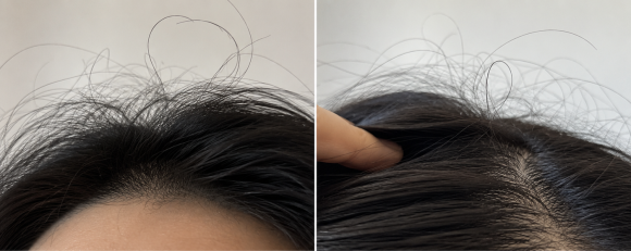 Why Do Coarse, Curly Hairs Grow on the Head? Is It Normal? Causes and Care image 2