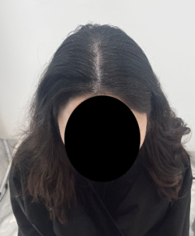 SMP후기, 두피문신 받고 자신감 회복한 30대 여성분 사례 관련 이미지 7