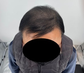 두피문신후기, 60대 남성 사례 전부 공개합니다 관련 이미지 9