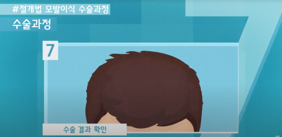 모발이식 수술 뉴헤어에서 알아보기(절개,비절개,헤어라인,모발이식방법,수술) 관련 이미지 7