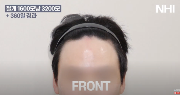 [뉴헤어] 남성 탈모 모발이식 1년 후 사진 공개합니다 관련 이미지 2