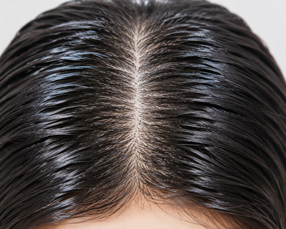 Does Hair Transplantation Graft Survival Vary by Skin Type? (Oily, Dry, and Thin Scalp) image 2