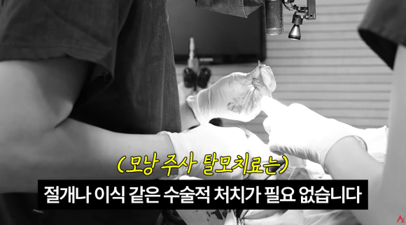 탈모 모낭주사 효과 진짜 있나요? (종류&middot;부작용) 관련 이미지 4