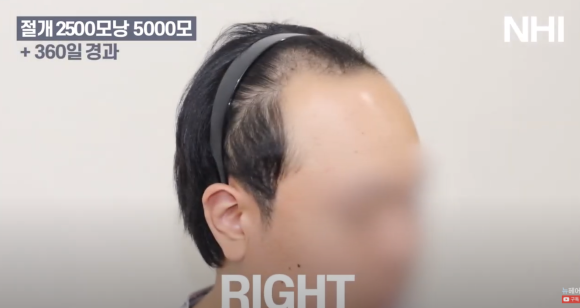 넓은 이마 모발이식 l 탈모 모발이식 후기 사진 관련 이미지 4
