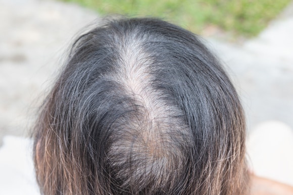 노화 탈모, 세포가 늙으면 머리카락도 늙는다? (탈모 실험을 통해본 노화와 탈모) 관련 이미지 1