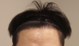 모발이식, 자연스러운 결과를 기대할 수 있을까? 관련 이미지 7
