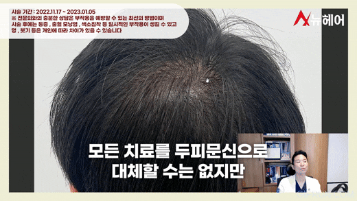 정수리두피문신 리얼 후기! 두피문신은 이런분들에게 추천합니다. 관련 이미지 8