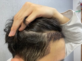 After a Hair Transplant, How Can You Return to Daily Life Without It Showing? image 2