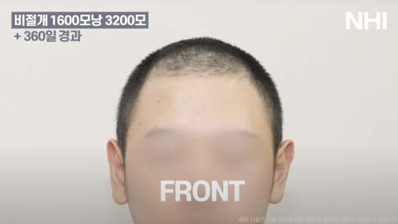 모발이식 비절개 1년 후기 전후사진 1600모낭 관련 이미지 1