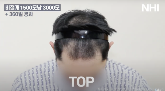 비절개 모발이식 후기 1년 사진 l 암흑기 지나고 후기 관련 이미지 5