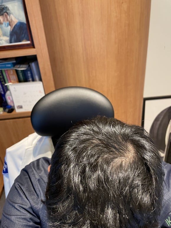 정수리 탈모는 모계 유전? 부계 유전? 한 세대걸러 탈모? 관련 이미지 5