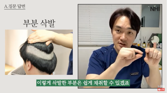 모발이식비용 방법에 따라 다를수 있다 관련 이미지 10
