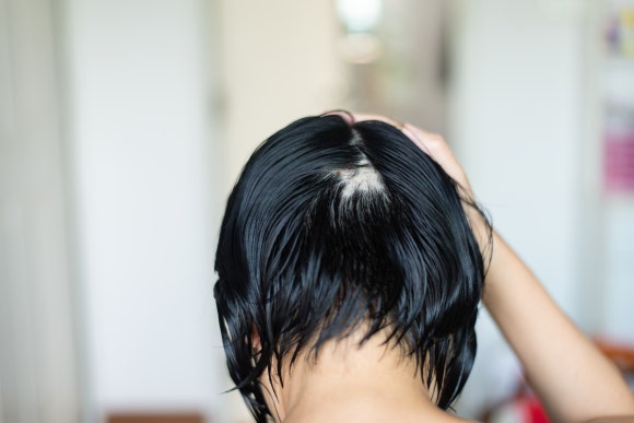 A Study on Alopecia Areata Treatments: What Is Being Discussed About Cardiovascular Issues? image 1