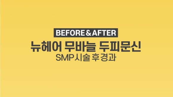 정수리, 가르마 두피문신 전후 사진 모음 ㅣ 뉴헤어 관련 이미지 1