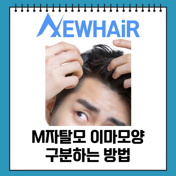 M자 모발이식 자신감을 심어드려요 관련 이미지 2
