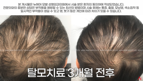 항암치료 후 탈모 극복, 이렇게 탈모치료하세요(탈모약, 영양제, 주사) 관련 이미지 2