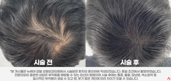 두피문신(SMP), 탈모 고민 완화를 돕는 새로운 방법? 관련 이미지 1