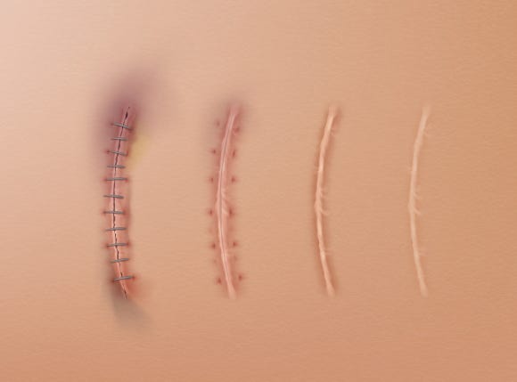 모발이식 채취 흉터를 줄이는                              트리암시놀론 주사 치료 관련 이미지 2