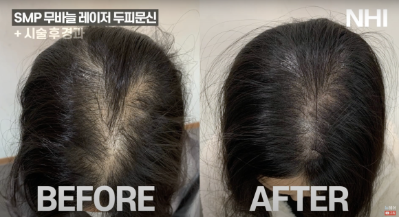 가르마 두피문신 후기 전후사진 l 여성 탈모치료 두피문신 관련 이미지 1