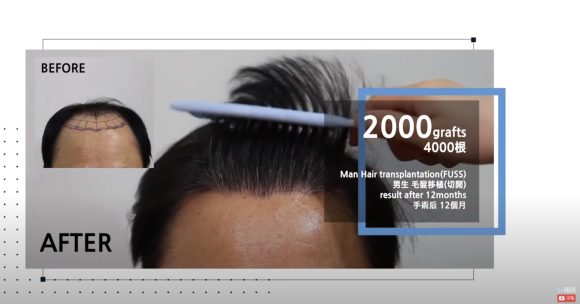 모발이식 전후 영상 l 1년 후 결과 관련 이미지 2
