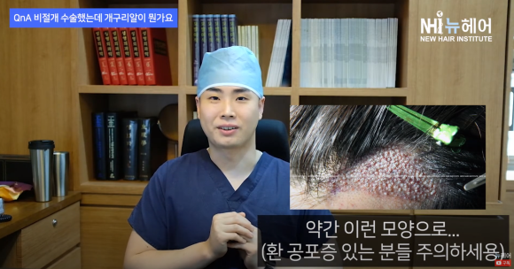 [뉴헤어] 모발이식 개구리알?! 관리 이렇게 하세요 관련 이미지 2