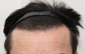 How Should You Start a Hair Loss Management Plan at First? image 1
