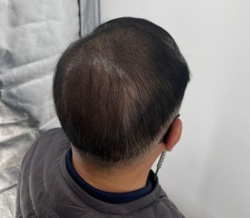 두피문신후기, 60대 남성 사례 전부 공개합니다 관련 이미지 15