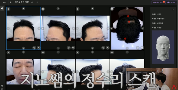 탈모약 중단, 끊으면 한 번에 머리카락 다 빠질까? 관련 이미지 5