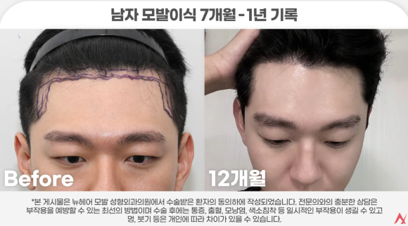 모발이식, 정말 해볼 만한가?(고민 중이라면 읽어야 할 글) 관련 이미지 2