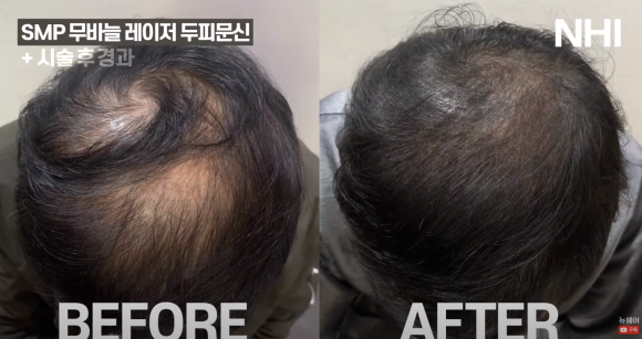 #정수리탈모 두피문신 전후사진 보기 관련 이미지 2