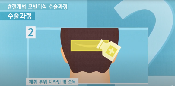 모발이식 수술 뉴헤어에서 알아보기(절개,비절개,헤어라인,모발이식방법,수술) 관련 이미지 3