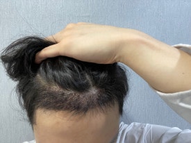 After a Hair Transplant, How Can You Return to Daily Life Without It Showing? image 1