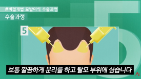 모발이식 절개&middot;비절개보다 중요한 것은? 결과를 좌우하는 5가지 관련 이미지 4