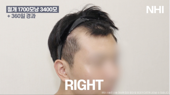 모발이식으로 엠자라인 벗어난 1년 후기 사진 l 1700모낭 이식 l 유전성탈모 관련 이미지 4