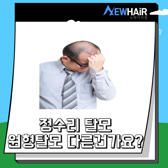 정수리탈모치료 더 늦지 않게 관련 이미지 3