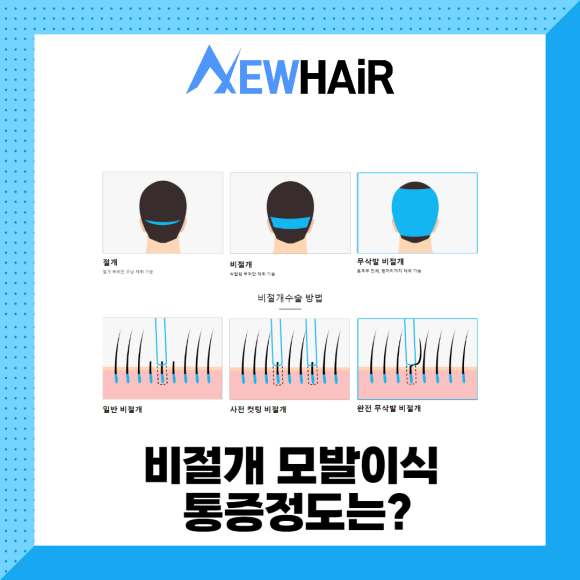 비절개모발이식 고민한다면 관련 이미지 4