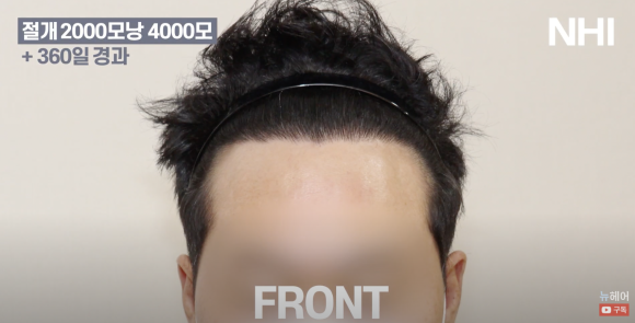 [뉴헤어] 남자 모발이식 2000모낭(4000모) 전후 비교 l 엠자이마 l 탈모 관련 이미지 3