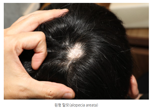 중증 원형탈모, 새로운 치료 접근법은?(유파다시티닙 or 우파다시티닙) 관련 이미지 1