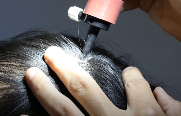 Hairline Scalp Micropigmentation: Procedures for a Natural Look image 1