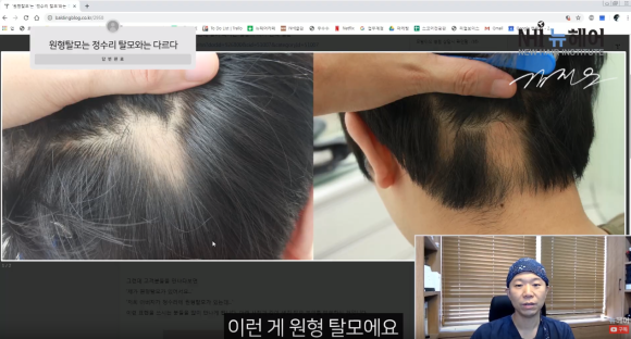 정수리 탈모 &ne; 원형 탈모 l  탈모 유형 구분법 관련 이미지 3