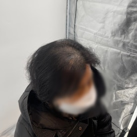 여성두피문신? 60대 실제 사례 사진으로 확인하세요 관련 이미지 5