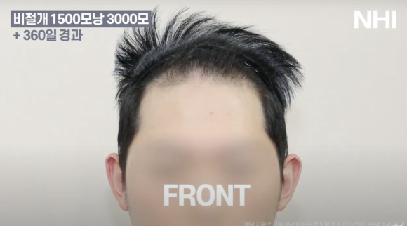 비절개 모발이식 후기 1년 사진 l 암흑기 지나고 후기 관련 이미지 1