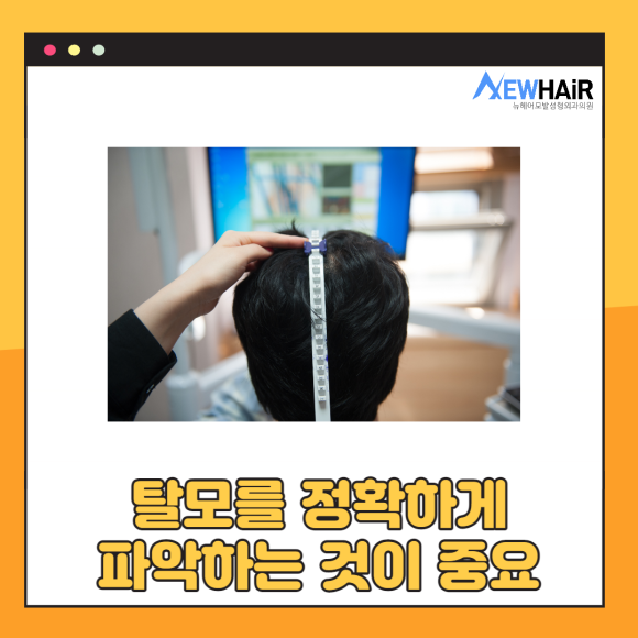 탈모정밀검사로 탈모검사 확실하게 관련 이미지 2