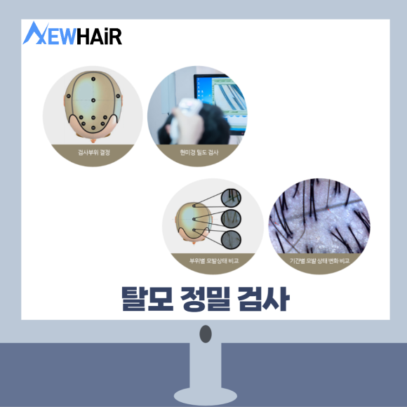 탈모검사비용 제대로 알고 치료하자 관련 이미지 7