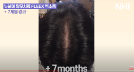 뉴헤어 탈모치료 모낭주사 7개월 전후 사진 관련 이미지 3
