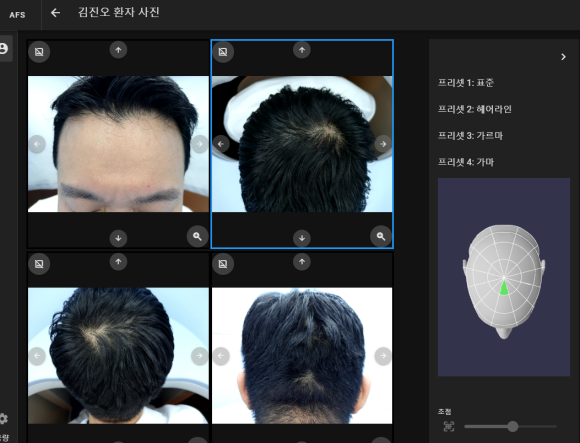 탈모 검사 정기적으로 받아야 합니다. 관련 이미지 10