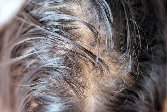 [Health Chosun] Kim Jin-oh's Ma Nari-za - 5 | Oily scalp: It’s already sad that hair gets greasy... but is it also more prone to hair loss? image 1