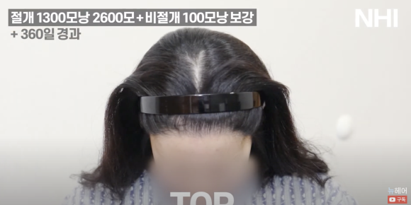 여자 모발이식 재수술 헤어라인교정 l  1300모낭 1년 경과 사진 l 3차 재수술 관련 이미지 6